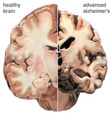 alzheimers-brain