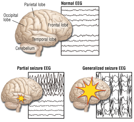 Epilepsy understood